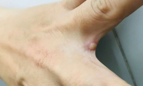 Đắk Lắk có ca nghi mắc đậu mùa khỉ đi du lịch từ nước ngoài về 