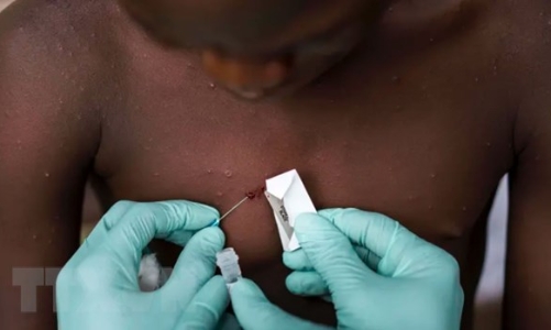 Mỹ cấp phép khẩn xét nghiệm bệnh đậu mùa khỉ của hãng Roche 