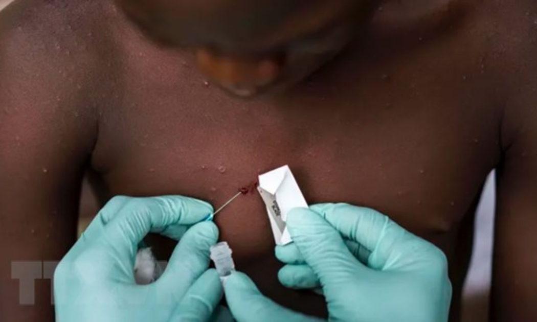 Nhân viên y tế điều trị cho một bệnh nhân mắc bệnh đậu mùa khỉ tại Nigeria. Ảnh: Getty Images