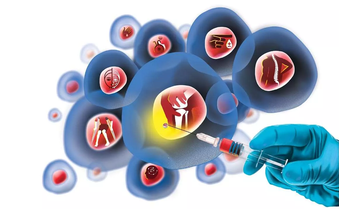 Liệu ph&aacute;p tế b&agrave;o gốc hiện đang được thế giới nghi&ecirc;n cứu để ứng dụng v&agrave;o điều trị nhiều căn bệnh kh&aacute;c nhau.