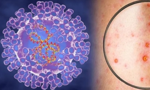 Đã có kết quả giải mã gene ca đậu mùa khỉ nội địa đầu tiên 