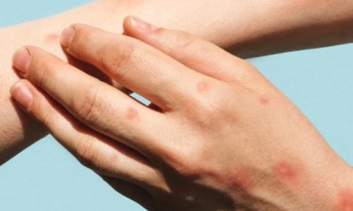 Việt Nam ghi nhận 56 ca bệnh đậu mùa khỉ tại 7 tỉnh/ thành, riêng  TP. HCM có 46 ca