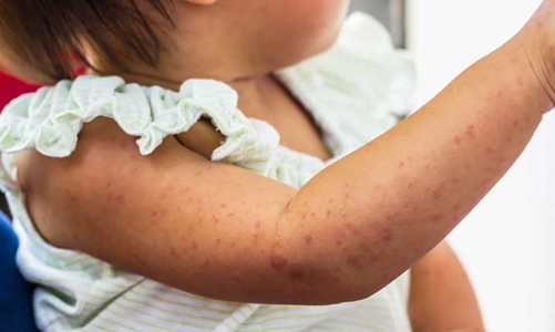 Gia tăng nguy cơ mắc bệnh truyền nhiễm, Bộ Y tế yêu cầu tăng cường phòng chống 