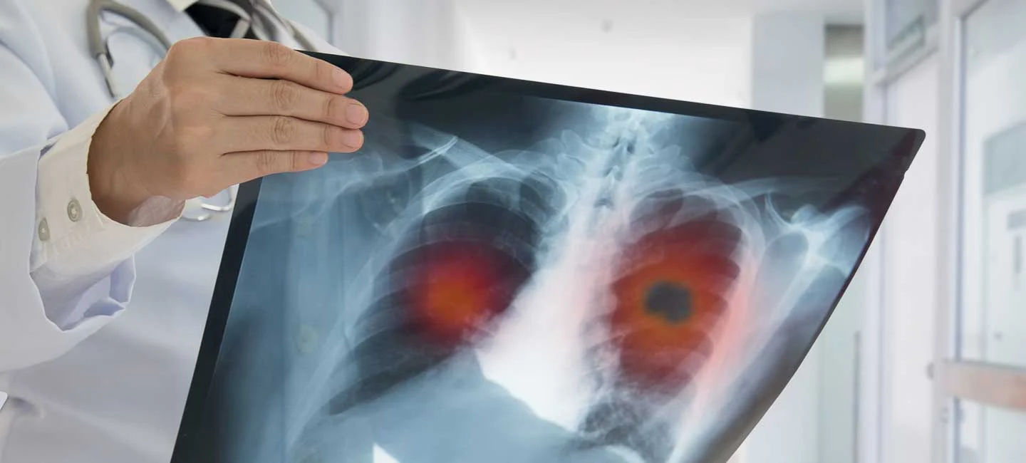 C&ocirc;ng ty cũng đang thử nghiệm tarlatamab để điều trị cho bệnh nh&acirc;n ung thư phổi tế b&agrave;o nhỏ giai đoạn đầu.