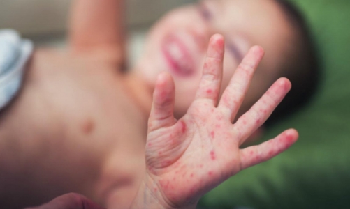 Gia tăng số trẻ em mắc bệnh tay chân miệng tại TP.HCM và khu vực phía Nam