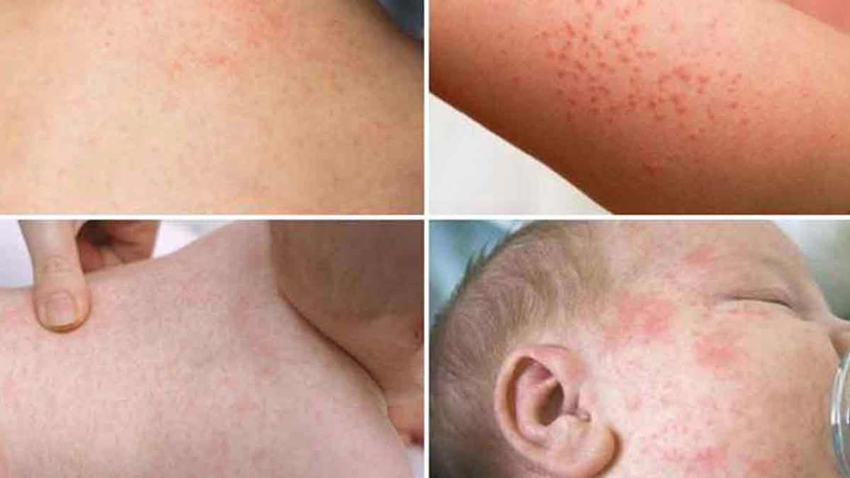 Gia tăng các biện pháp phòng chống nguy cơ bùng phát dịch sởi tại khu vực  phía Nam - Nhịp sống kinh tế Việt Nam & Thế giới