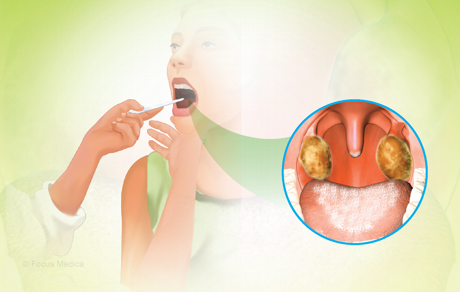 Hồi tháng 4 năm nay, WHO đã cảnh báo rằng bệnh bạch hầu đang gia tăng trên toàn cầu.