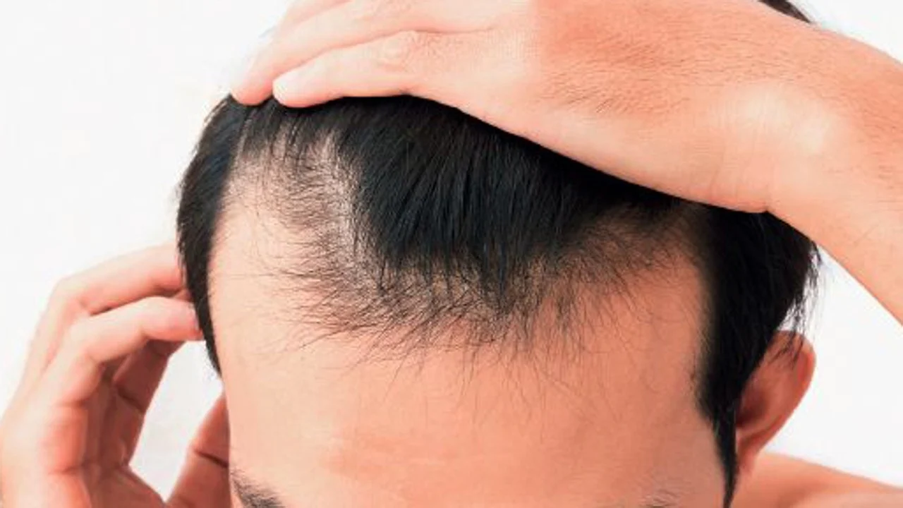 Tại châu Á, chứng rụng tóc, hói đầu không chỉ khiến người Hàn Quốc quan tâm.