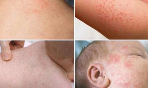 Ca mắc sởi tăng nhanh, TP.HCM tăng cường kiểm soát lây nhiễm sởi trong cộng đồng