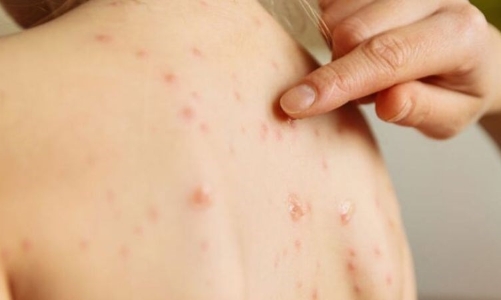 TP. HCM đủ điều kiện công bố dịch sởi