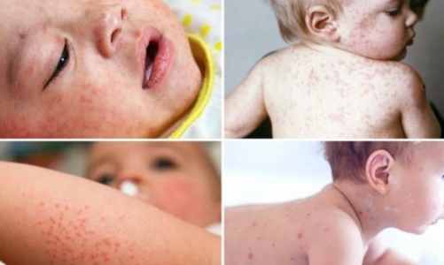 TP.HCM công bố dịch sởi