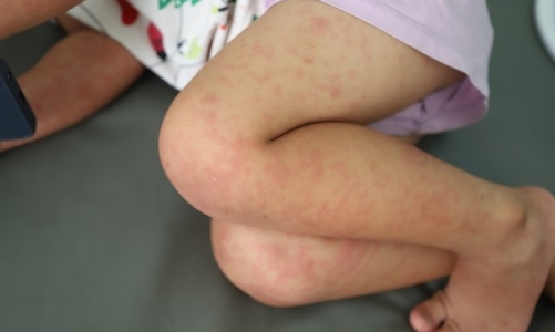 TP.HCM lo thiếu thuốc điều trị khi dịch sởi tiếp tục gia tăng