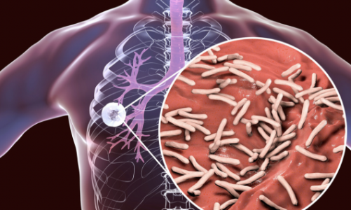 Việt Nam là nước có gánh nặng bệnh lao cao