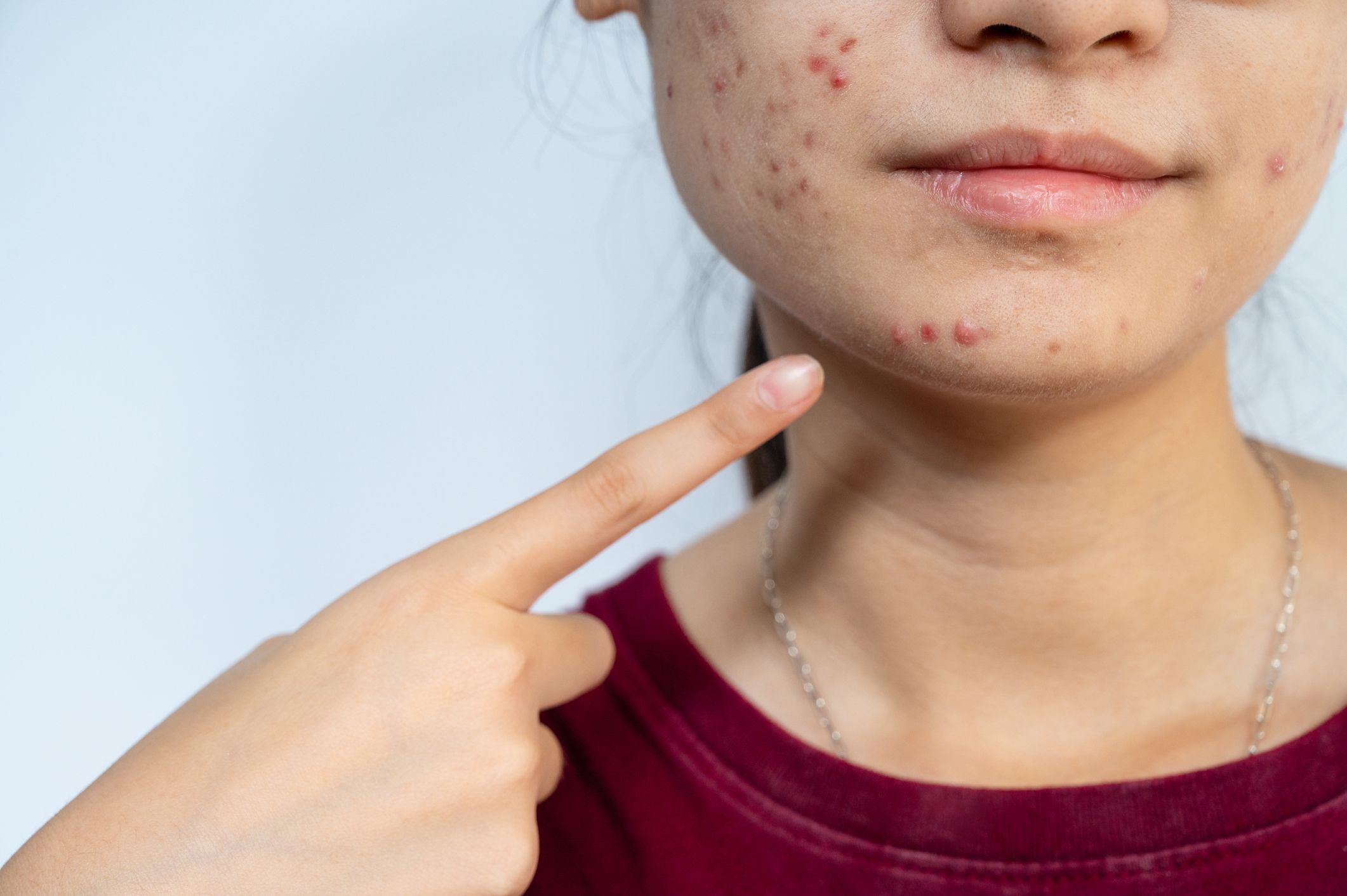 Bệnh “trứng cá đỏ” có nguyên nhân từ ô nhiễm không khí.