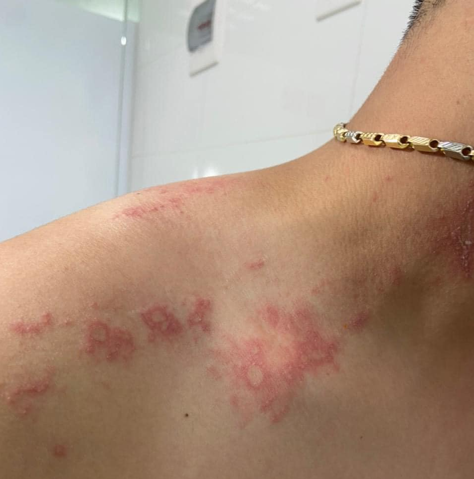 Có những người khi thấy da bị mẩn ngứa đỏ rát thì lại cho rằng mình bị bệnh zona thần kinh.