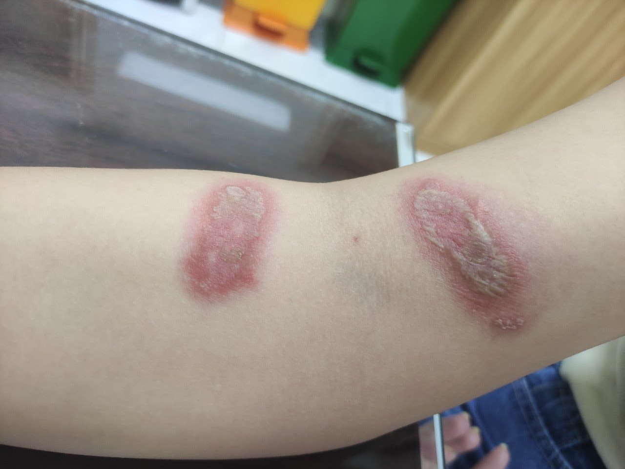 Nếu lỡ tay đập hoặc chà xát kiến ba khoang trên da, phải nhanh chóng rửa sạch nơi tiếp xúc bằng nước sạch hoặc nước muối sinh lý.