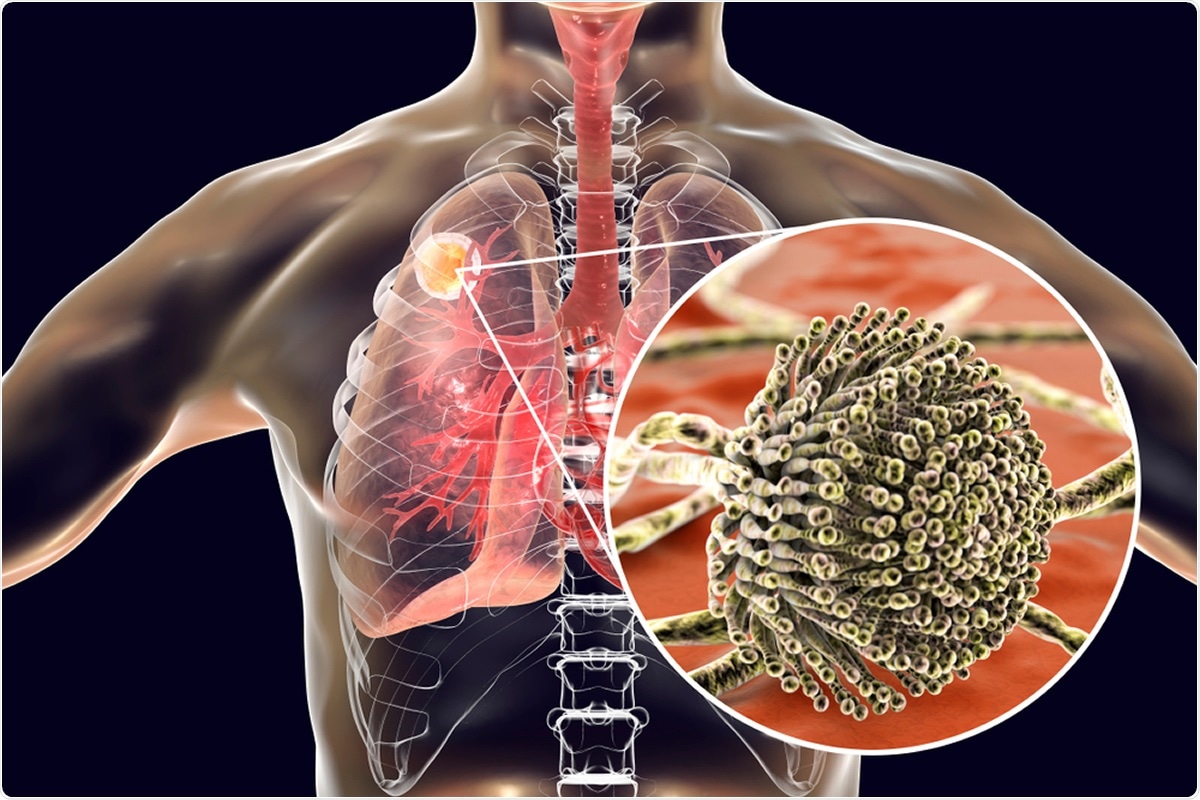 Khoảng 50% bệnh nh&acirc;n từng mắc lao phổi khi t&aacute;i kh&aacute;m được chẩn đo&aacute;n nhiễm nấm Aspergillus.