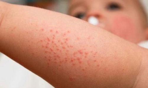 Bộ Y tế thông tin về việc hàng trăm trẻ sốt phát ban tại Quảng Nam 