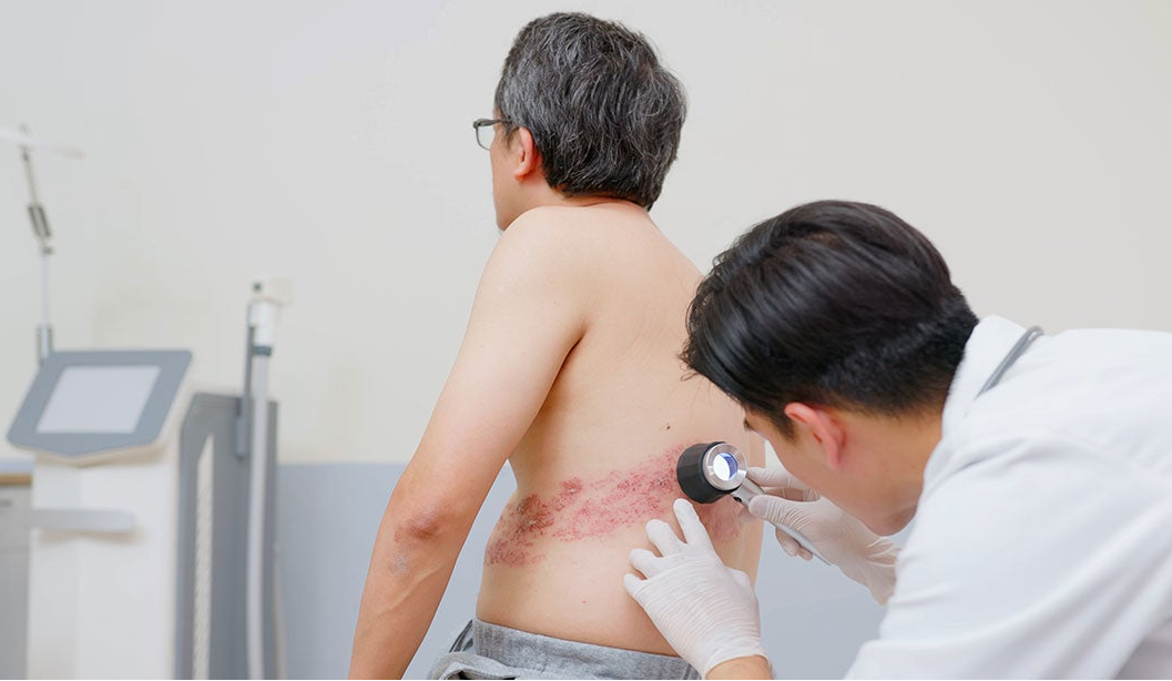 Việc điều trị c&aacute;c biến chứng zona c&oacute; thể k&eacute;o d&agrave;i, tốn k&eacute;m chi ph&iacute;, đặc biệt đối với người lớn tuổi, người c&oacute; bệnh nền, g&acirc;y &aacute;p lực l&ecirc;n hệ thống y tế.