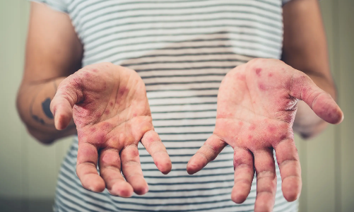 Người lớn mắc sởi dễ có biến chứng nguy hiểm