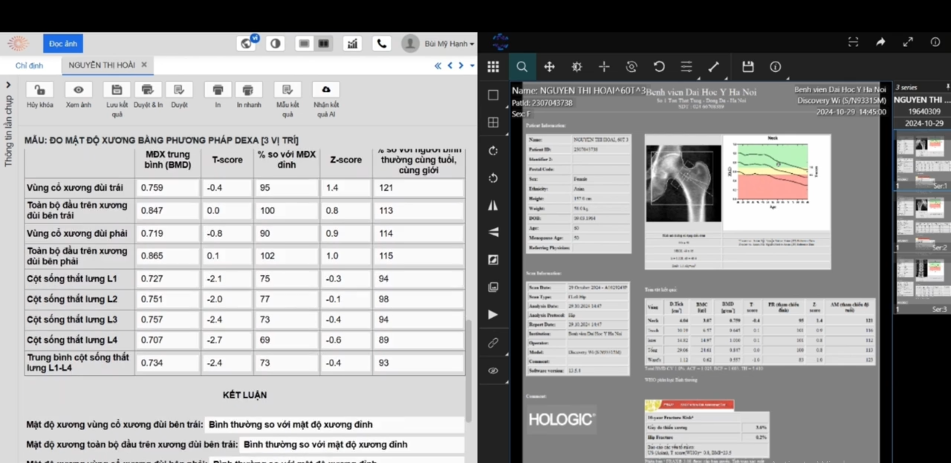 Đưa m&ocirc; h&igrave;nh AI v&agrave;o quy tr&igrave;nh kh&aacute;m, đo mật độ xương.