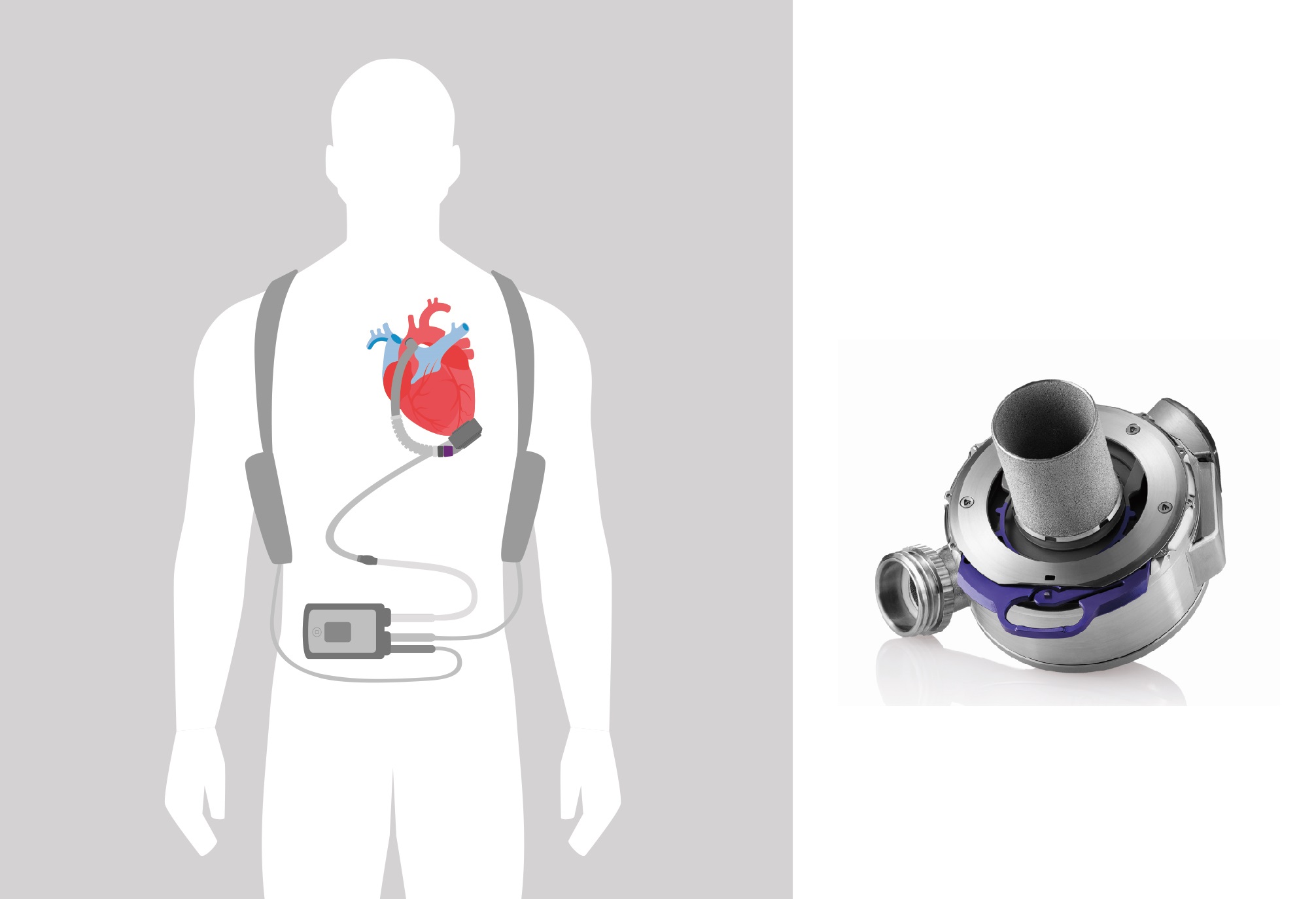 LVAD- Heart Mate3 hoạt động như một chiếc bơm cơ học.