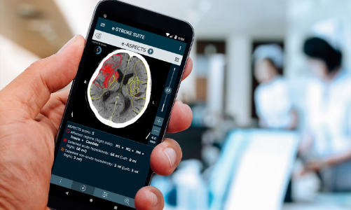 “Bác sỹ AI” giúp điều trị đột quỵ
