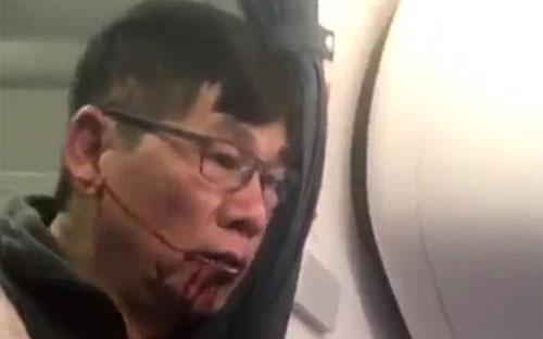 Ông David Dao bị đánh bầm dập trên chuyến bay của United Airlines - Ảnh: Twitter/Daily Mail.<br>