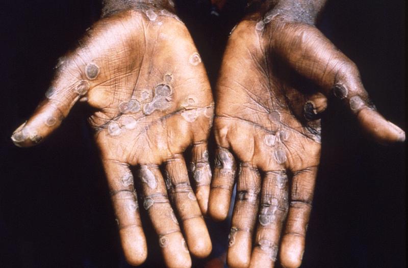 Lòng bàn tay của một bệnh nhân mắc bệnh đậu mùa ở khỉ ở Lodja, một thành phố nằm trong Khu Y tế Katako-Kombe ở Cộng hòa Dân chủ Congo vào năm 1997 - Ảnh: Reuters