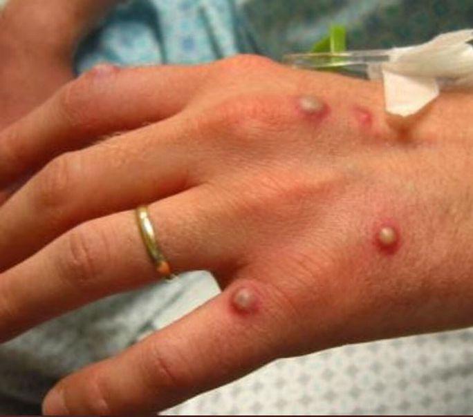 Bàn tay một bệnh nhân đậu mùa khỉ nổi mụn nước Ảnh: MEDSCAPE