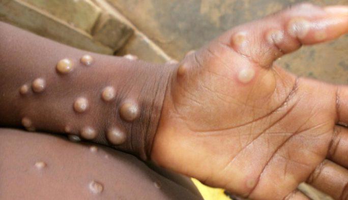 Bệnh nhân mắc đậu mùa khỉ ở Congo - Ảnh: WHO