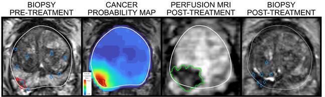 Hình MRI nơi có tế bào ung thư được lập bản đồ bằng phần mềm iQuest của Avenda Healt