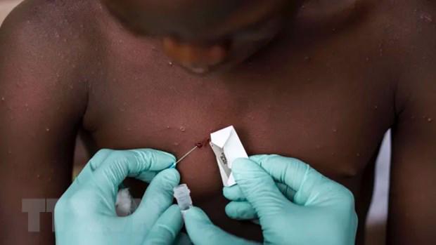 Nhân viên y tế điều trị cho một bệnh nhân mắc bệnh đậu mùa khỉ tại Nigeria. Ảnh: Getty Images