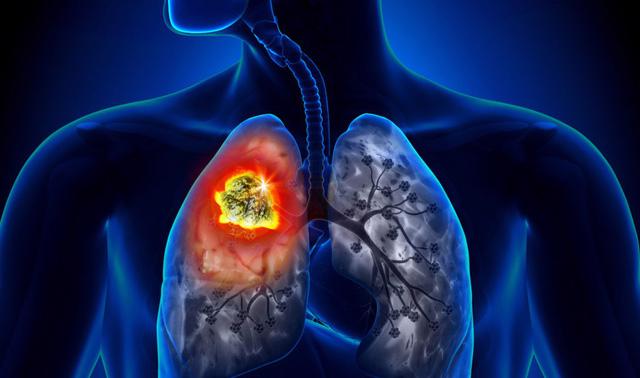 Phát hiện sớm ung thư phổi bằng trí tuệ nhân tạo - Ảnh 1.