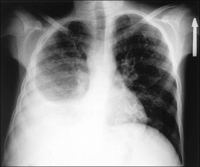Điều trị tràn dịch màng phổi phải dựa vào nguyên nhân - Ảnh 1.