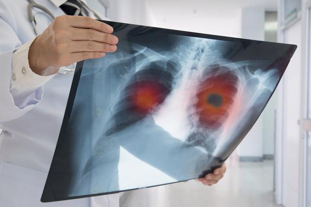 Điều trị tràn dịch màng phổi phải dựa vào nguyên nhân - Ảnh 2.