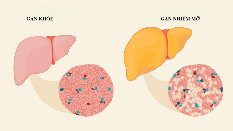 Bệnh gan nhiễm mỡ vẫn chưa được nhìn nhận đúng mức - Ảnh 1