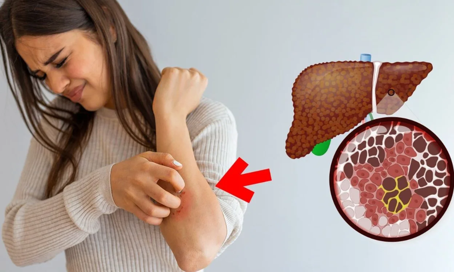 Sụt cân không rõ nguyên nhân, vàng da, ngứa ngáy... có thể là triệu chứng của gan nhiễm mỡ.